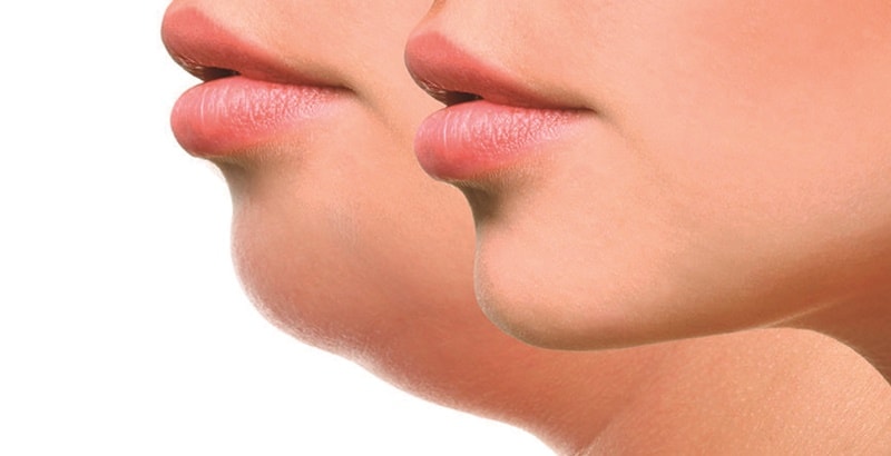 Bài tập loại bỏ “cằm hai nọng”