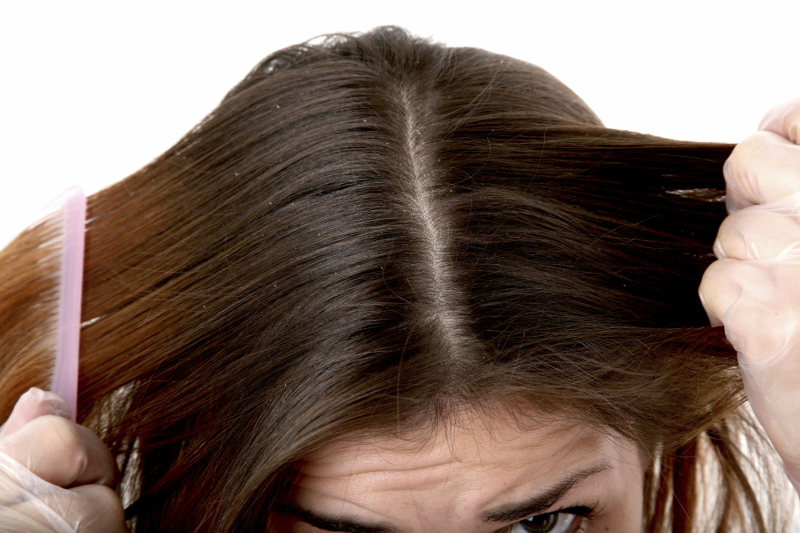 Hãy thử áp dụng các cách trị gàu đơn giản nhưng hiệu quả tại gia để bảo vệ da đầu & nang tóc của mình.