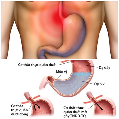 Đau dạ dày ảnh hưởng vùng ức