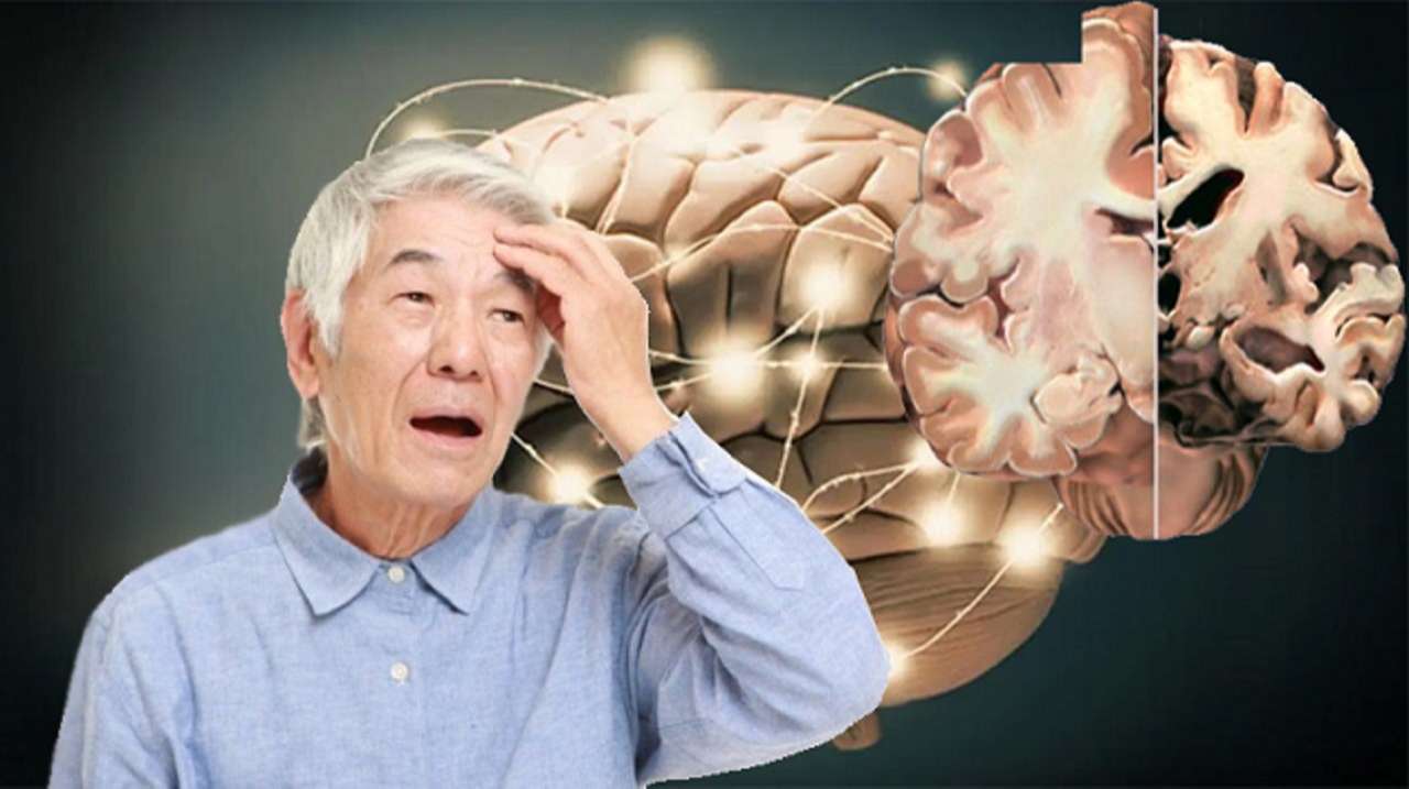 Giảm bệnh Alzheimer