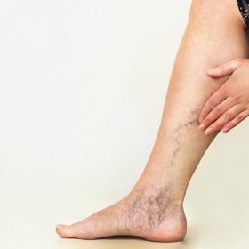 Phương Pháp Massage Với Dầu Olive Hỗ Trợ Điều Trị Suy Giãn Tĩnh Mạch