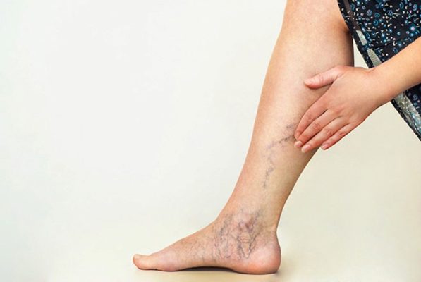 Phương Pháp Massage Với Dầu Olive Hỗ Trợ Điều Trị Suy Giãn Tĩnh Mạch