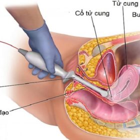 Siêu âm đầu giò là gì? Siêu âm đầu dò có hại không?