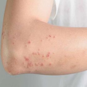 Bệnh giun đũa chó nên kiêng ăn những thực phẩm gì?