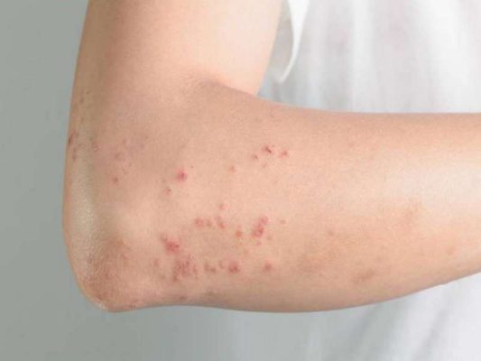 Bệnh giun đũa chó nên kiêng ăn những thực phẩm gì?