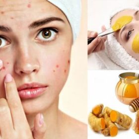 Mẹo trị mụn bằng phương pháp thiên nhiên hiệu quả ngay tại nhà