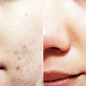 Bật mí những cách trị thâm mụn hiệu quả. an toàn ngay tại nhà