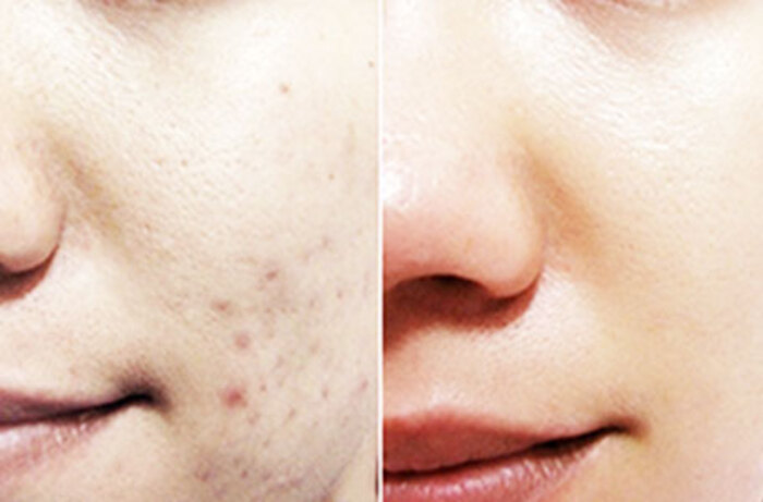 Bật mí những cách trị thâm mụn hiệu quả. an toàn ngay tại nhà