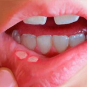 Bị nhiệt miệng uống thuốc gì để bệnh hồi phục nhanh?