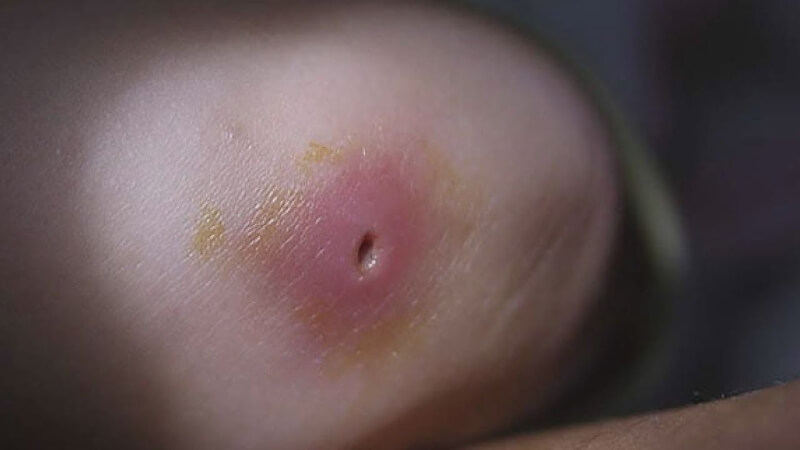 Có nên nặn mủ vết thương? Phương pháp nặn đúng cách