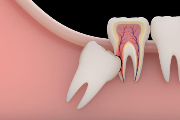 Có nên nhổ răng số 8, việc nhổ có ảnh hưởng gì không?