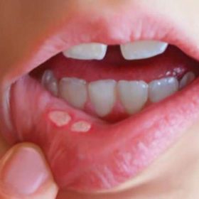 Chia sẻ bật mí 10 cách chữa lở miệng tại nhà hiệu quả tốt nhất nên biết