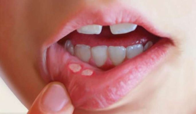Chia sẻ bật mí 10 cách chữa lở miệng tại nhà hiệu quả tốt nhất nên biết