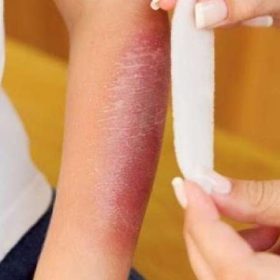 Hỏi đáp ngay: Bị bỏng kiêng ăn gì?