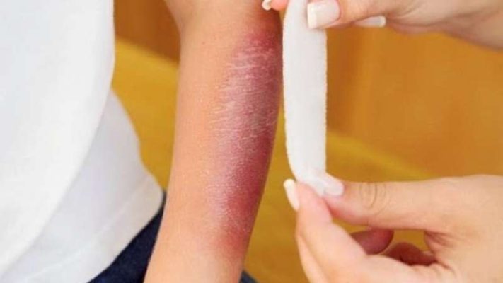 Hỏi đáp ngay: Bị bỏng kiêng ăn gì?