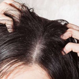 Share ngay các cách trị gàu đơn giản nhưng hiệu quả tại gia