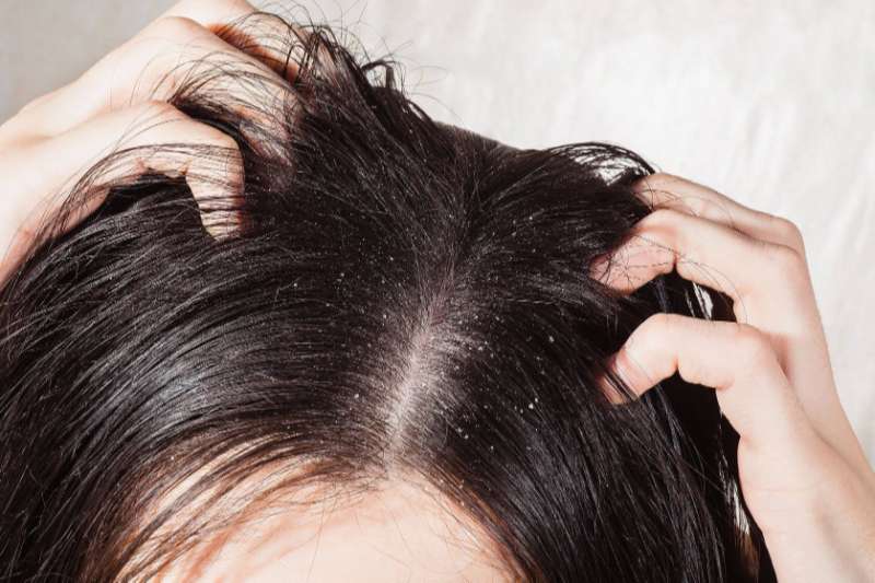 Share ngay các cách trị gàu đơn giản nhưng hiệu quả tại gia