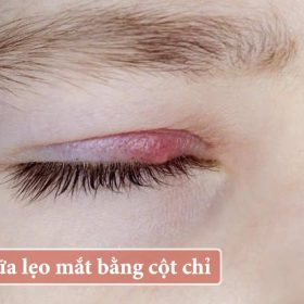 Chia sẻ mẹo chữa lẹo mắt cột chỉ tại nhà