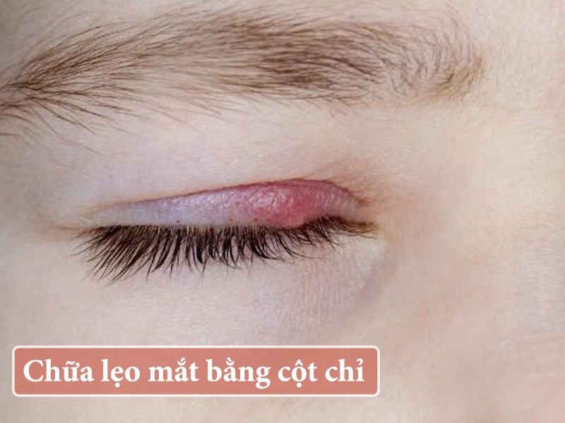 Chia sẻ mẹo chữa lẹo mắt cột chỉ tại nhà