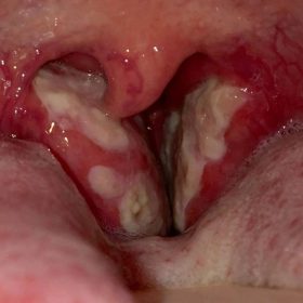 Chia sẻ mẹo chữa viêm amidan hốc mủ an toàn, hiệu quả nhanh chóng