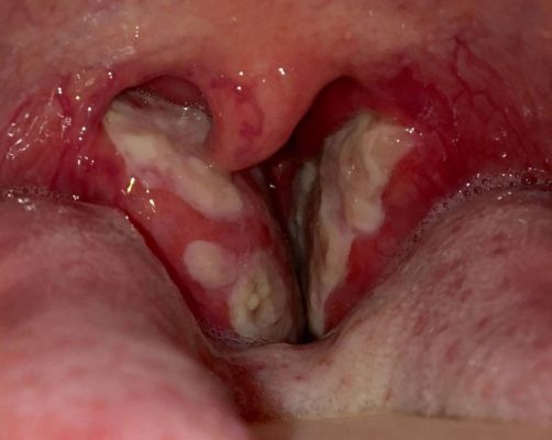 Chia sẻ mẹo chữa viêm amidan hốc mủ an toàn, hiệu quả nhanh chóng