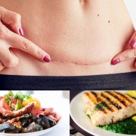 Sản phụ sinh mổ kiêng ăn gì mới nhanh lành?
