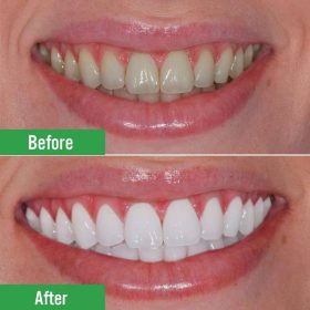 Bật mí tips tẩy trắng răng tại nhà không khó với những nguyên liệu trong bếp