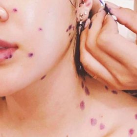 Giải đáp: Người bị thủy đậu nên ăn gì để nhanh khỏi?