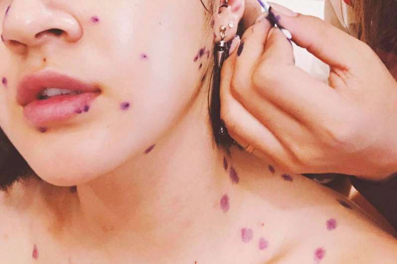 Giải đáp: Người bị thủy đậu nên ăn gì để nhanh khỏi?